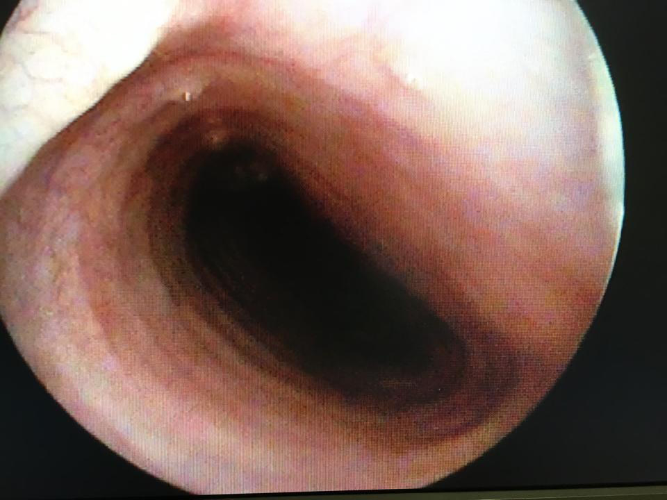 Trachealkollaps